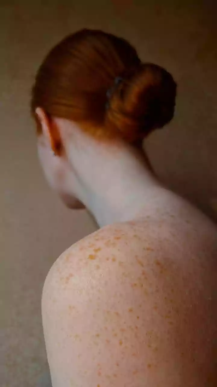 Melanoma: a regra de ouro para identificar o câncer de pele mais agressivo