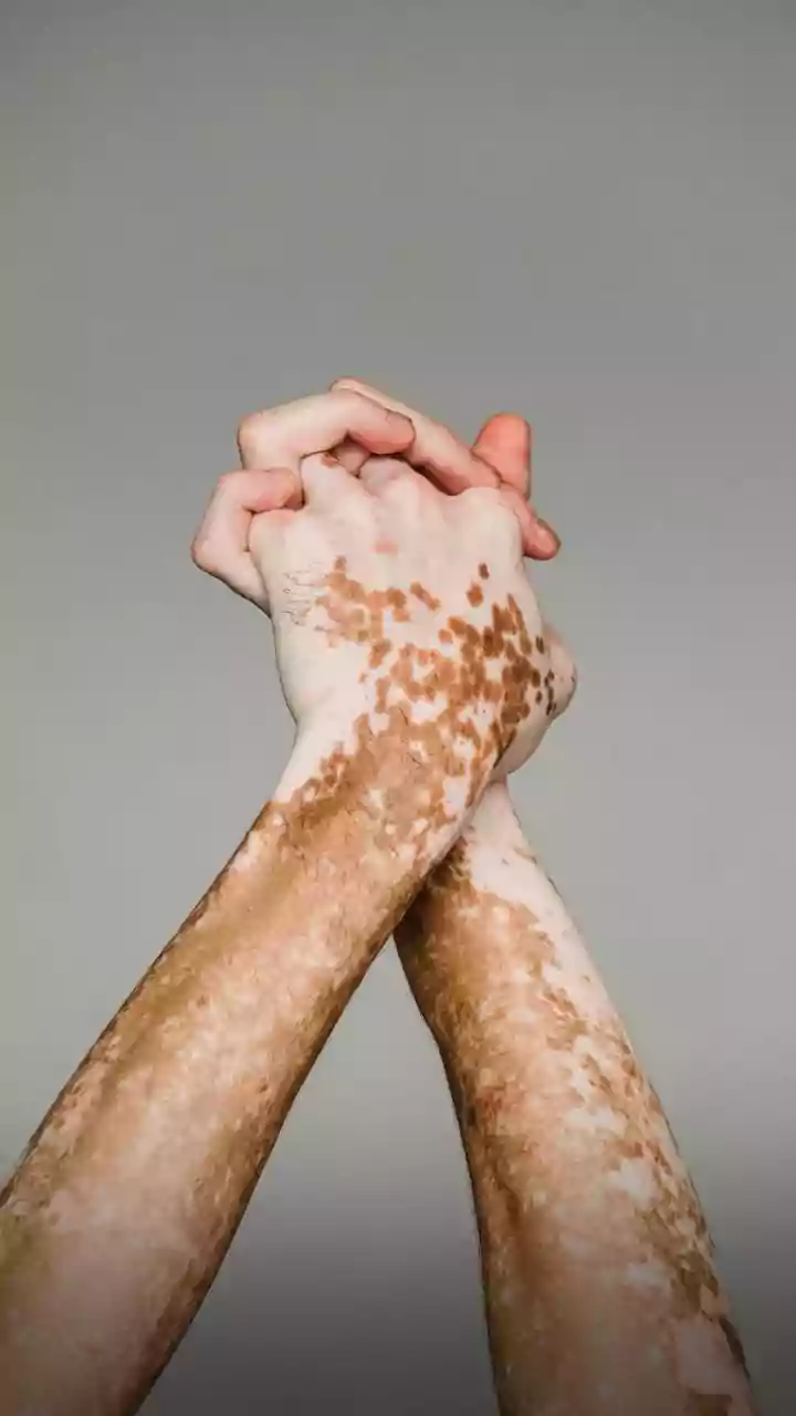 Unmasking Autoimmune Diseases: Early Signs and How They Evolve