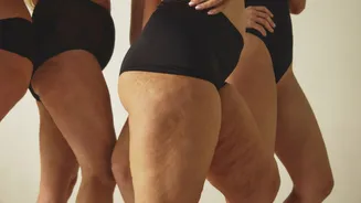 Quando sei que é lipedema ou celulite? Entenda as diferenças