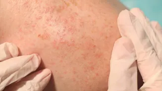 Fix mild heat rash at home with these remedies