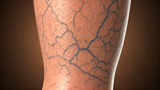 Varicose Veins: Daily Habits to Avoid