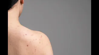 Penyebab Jerawat Punggung yang Wajib Kamu Ketahui