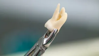 Dente do siso: por que temos e quando é necessário tirar?