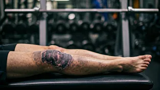 Noida Workout Injuries: Exercise Mishaps Rise