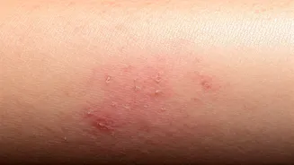 Dermatitis vs. Eczema: Decoding Skin Inflammation for Healthy Skin