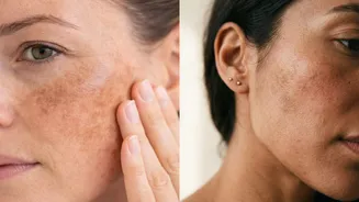 Adeus manchas: o tratamento que você deve começar a fazer no inverno para ter resultados reais