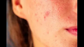 Salicylic Acid Explained: How The Ingredient Targets Pimples And Clogged Pores