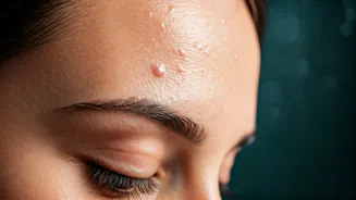 Breakouts During Monsoon Need Better Skin Habits