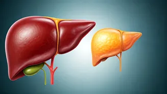 Unveiling Fatty Liver: A 4-Stage Guide