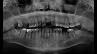 Not just a health crisis: How oral cancer is silently becoming an economic issue