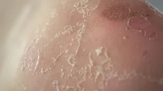 Fix flaky chest skin with these home remedies