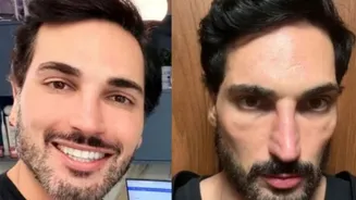 Influenciador choca ao revelar efeito de caneta emagrecedora no rosto