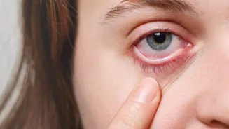 Have eyelid swelling? Fix it with these remedies