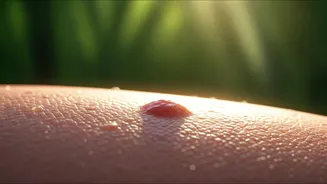 Don't Treat Monsoon Acne Like Summer Pimples