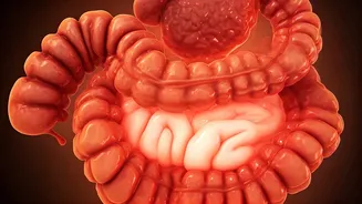 Unveiling Diverticulitis: Symptoms, Treatment & Prevention