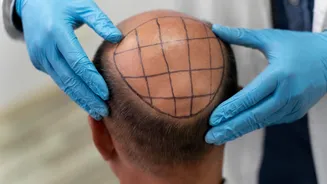 Mitos e verdades sobre transplante capilar: o que realmente importa antes de decidir pela cirurgia