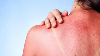 Natural remedies that can fix sunburn