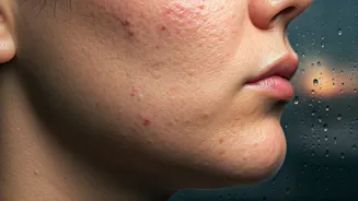 The Truth About Rainy Season Acne Flare-Ups