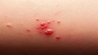 South Carolina Sees Soaring Measles Cases: 789 Reported