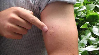 Fix itchy insect bites with these home remedies