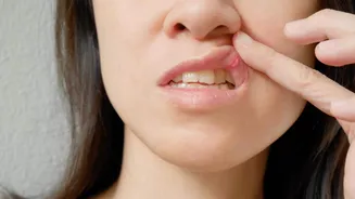 These natural remedies work like magic on mouth ulcers
