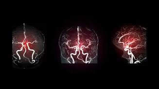 1 in 7 Young Indians Under 44 Are Suffering Strokes – The Rising Health Crisis Millennials Can’t Ignore