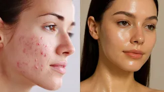 Struggling with summer breakouts? Here’s how to get rid of acne naturally