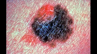 Melanoma: a regra de ouro para identificar o câncer de pele mais agressivo