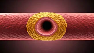 Artery Plaque Explained: Formation, Prevention, and Reversal