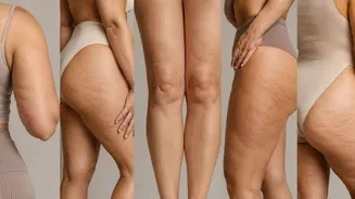 “Achei que fosse só no bumbum”: os lugares mais inesperados onde mulheres estão tratando a celulite