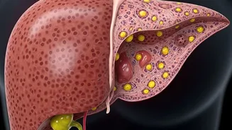 Non-alcoholic fatty liver disease: All you need to know about it