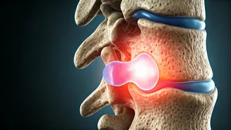 Unmasking Facet Joint Syndrome: A Surgeon's Guide to Chronic Back & Neck Pain