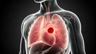 Pulmonary Thromboembolism: Understanding the Deadly Link to Heart Issues