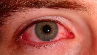Monsoon conjunctivitis prevention: Leading ophthalmologist shares essential eye health safety tips