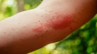 Soothe itchy insect bites with these home remedies