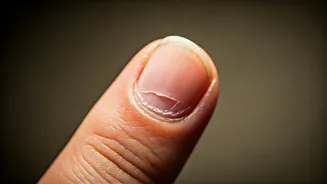 Peeling Nails? Find Out Why and How to Fix It