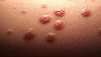 Unveiling Diabetic Skin Rashes: Subtle Signs and What to Watch For