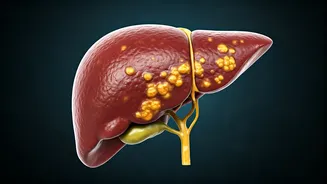Fatty Liver: The Growing Health Concern You Should Know