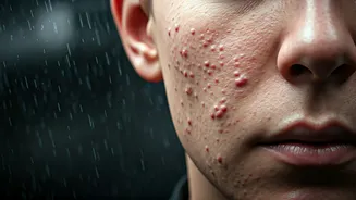 Rainy Season Acne Comes With Different Triggers