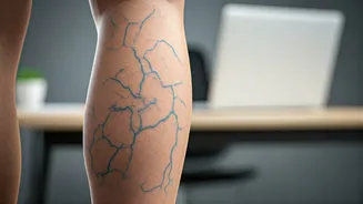 Desk Job Woes: Young Indians Grapple with Rising Varicose Veins and DVT
