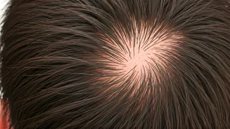 Navigating a Receding Hairline at 16: Expert Insights for Teens