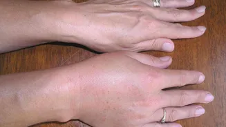 Fix mild hand swelling with these home remedies