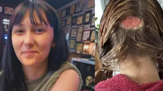 Hair Dye Disaster: Scalp Burn Led To Bald Spot