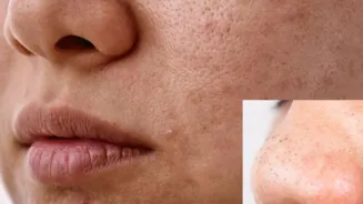 Remove Blackheads Easily With This Towel Trick