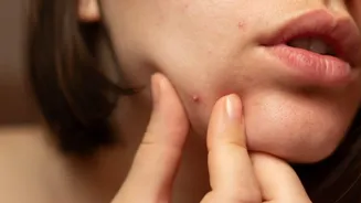 Sugar Overload: Acne, Ageing, and Inflammation