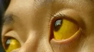 Jaundice: Spot the Warning Signs and Causes