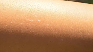 Sun Exposure May Cause White Spots on Skin