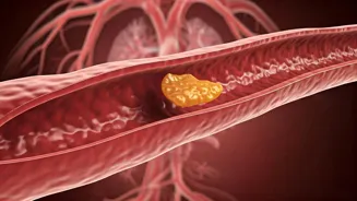 Clean Arteries Naturally and Reduce Plaque