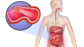 Crohn's Disease: How Does It Affect Your Body?